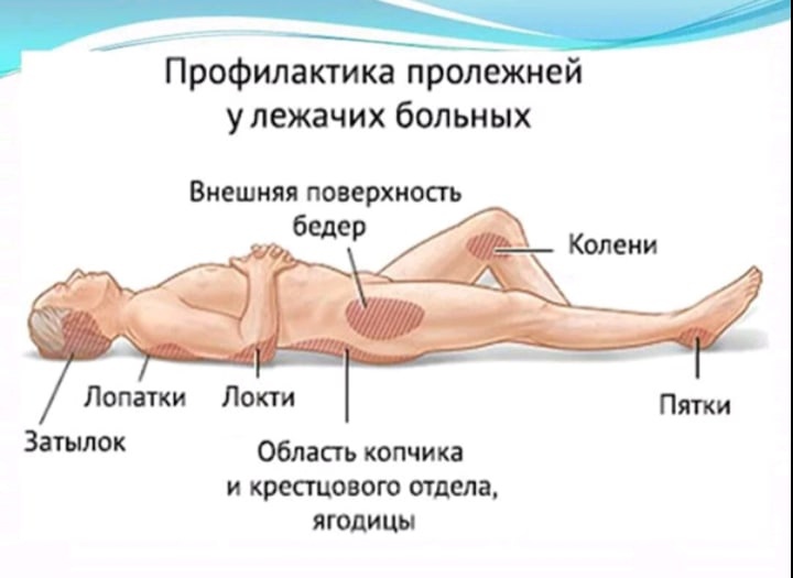 Профилактика пролежней